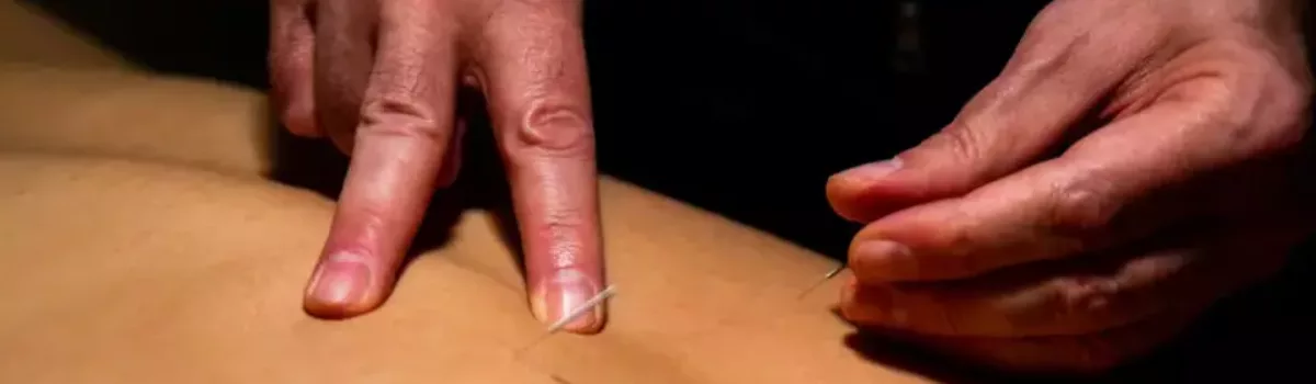 ACUPUNCTURE